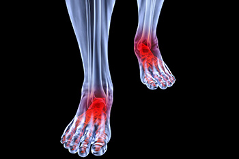 arthritic foot care in the Orange County, CA: Huntington Beach (Anaheim, Santa Ana, Irvine, Garden Grove, Orange, Costa Mesa, Westminster, Newport Beach, Tustin, Fountain Valley, Stanton, Seal Beach, Corona Del Mar, Los Alamitos, Rossmoor) areas