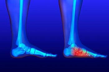 flat feet treatment in the Orange County, CA: Huntington Beach (Anaheim, Santa Ana, Irvine, Garden Grove, Orange, Costa Mesa, Westminster, Newport Beach, Tustin, Fountain Valley, Stanton, Seal Beach, Corona Del Mar, Los Alamitos, Rossmoor) areas