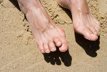 hammertoe and mallet toe treatment in the Orange County, CA: Huntington Beach (Anaheim, Santa Ana, Irvine, Garden Grove, Orange, Costa Mesa, Westminster, Newport Beach, Tustin, Fountain Valley, Stanton, Seal Beach, Corona Del Mar, Los Alamitos, Rossmoor) areas