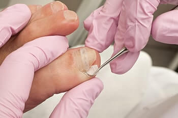 ingrown toenail treatment in the Orange County, CA: Huntington Beach (Anaheim, Santa Ana, Irvine, Garden Grove, Orange, Costa Mesa, Westminster, Newport Beach, Tustin, Fountain Valley, Stanton, Seal Beach, Corona Del Mar, Los Alamitos, Rossmoor) areas