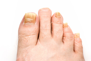 toenail fungus treatment in the Orange County, CA: Huntington Beach (Anaheim, Santa Ana, Irvine, Garden Grove, Orange, Costa Mesa, Westminster, Newport Beach, Tustin, Fountain Valley, Stanton, Seal Beach, Corona Del Mar, Los Alamitos, Rossmoor) areas