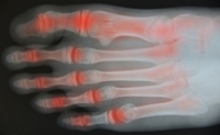 What Are the Signs and Symptoms of Rheumatoid Arthritis?