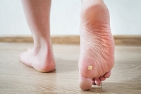 How to Know if You Have a Plantar Wart